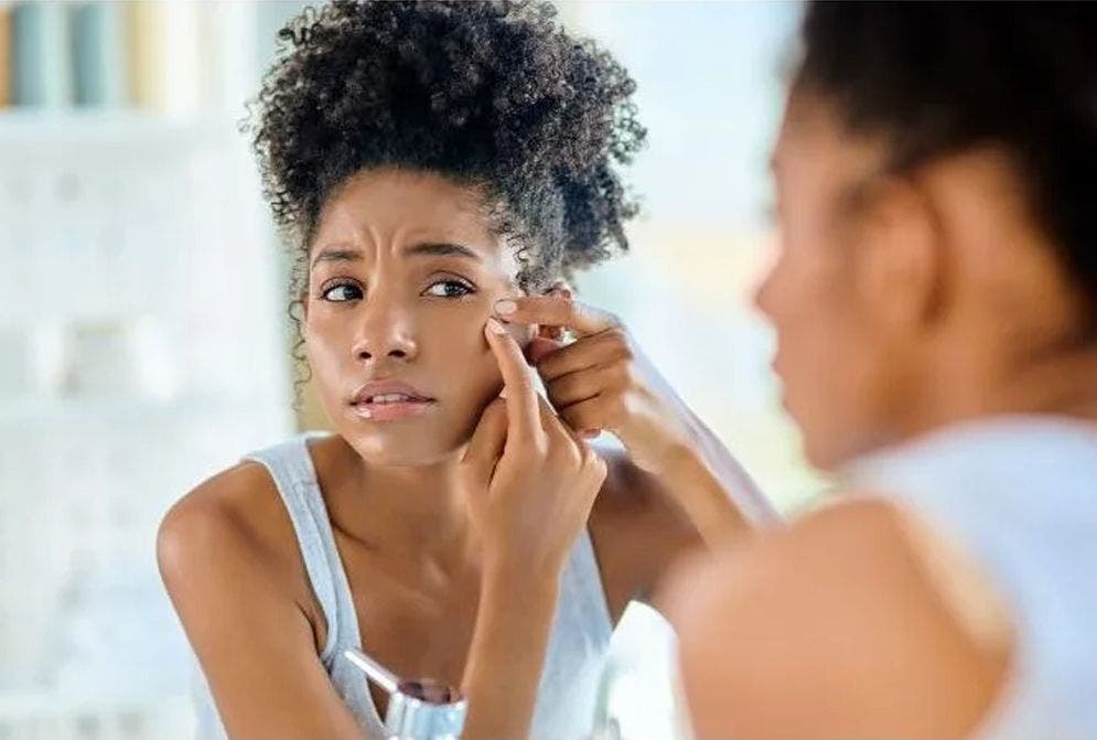 Pele com acne: causas, tratamento e quais produtos utilizar